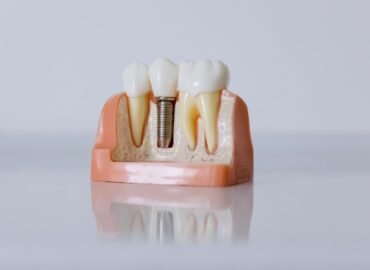 Implanty dentystyczne