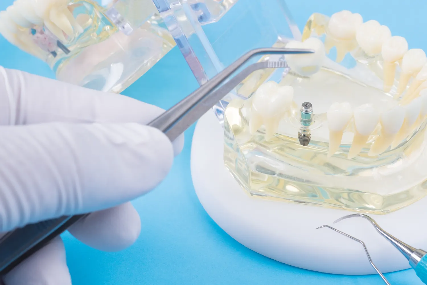 Czy implanty są na całe życie?