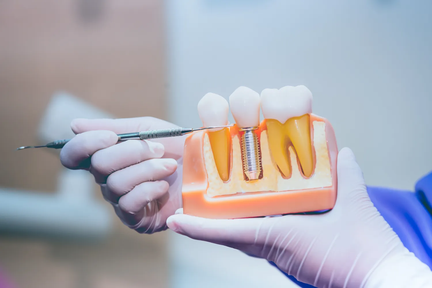 Rodzaje implantów zębowych