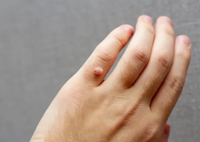 Co powoduje kurzajki?