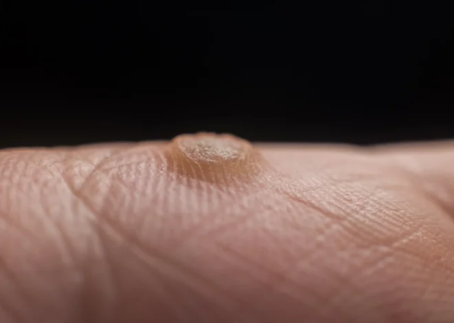 Co skutecznego na kurzajki?