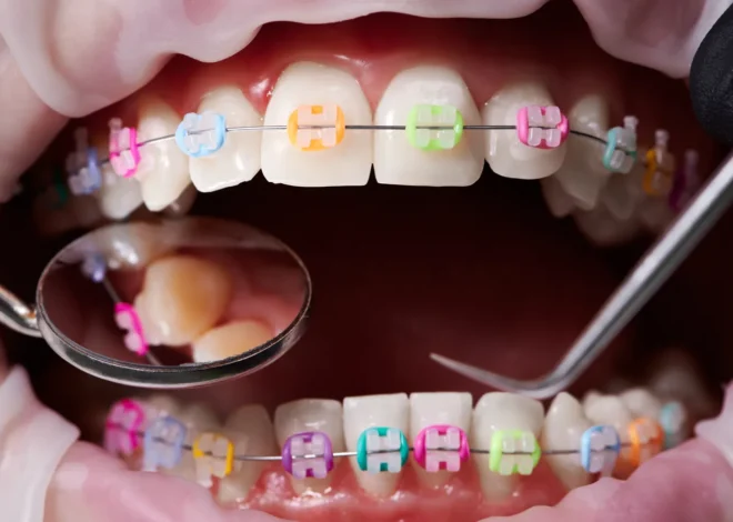 Czy warto zdecydować się na implanty zębowe?