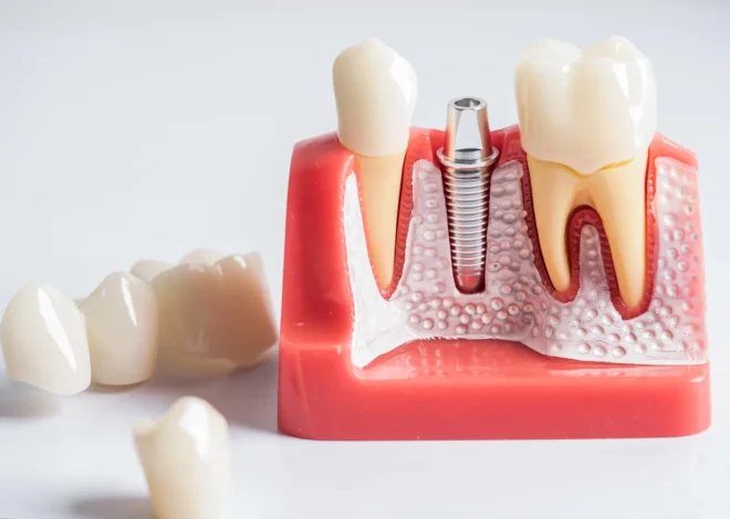 Implanty w jeden dzień Kołobrzeg