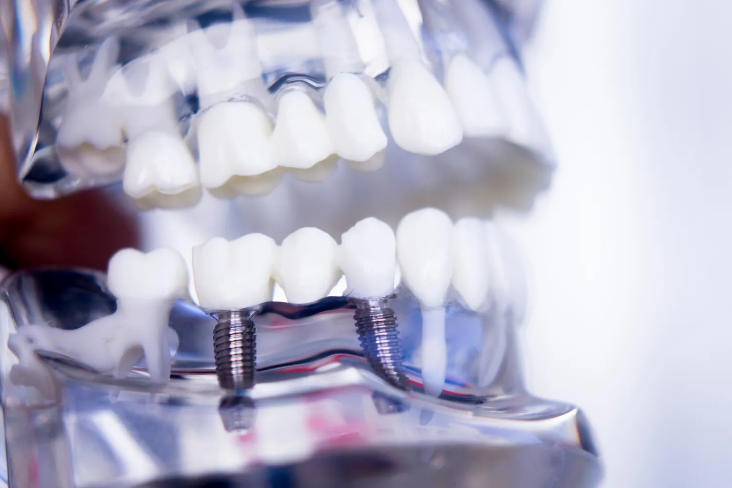 Implanty zębowe – proces zakładania implantu zębowego