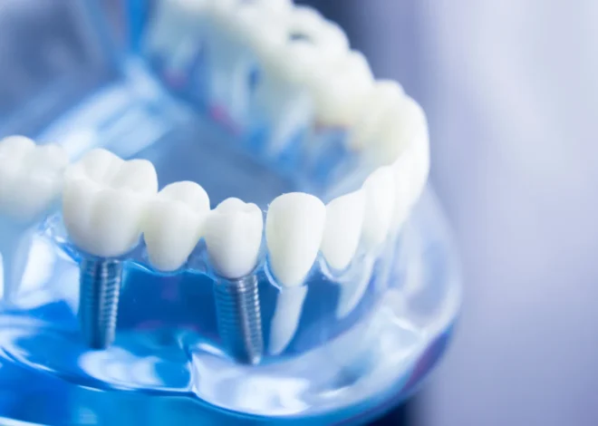 Stomatolog wykona odbudowę uzębienia przy pomocy implantów zębowych