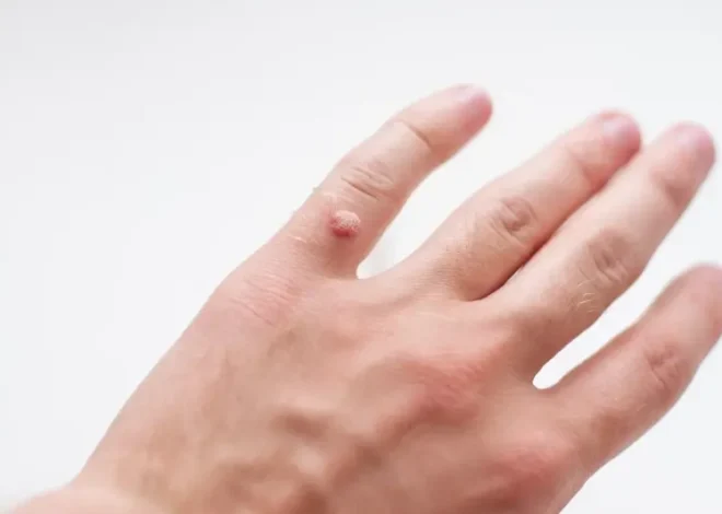 Dlaczego z kurzajki leci krew?