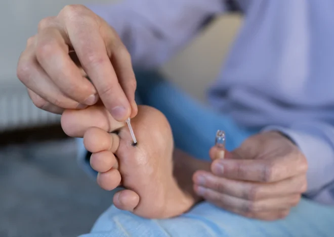 Ile kosztuje usunięcie kurzajki?