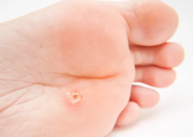 Jak podolog usuwa odcisk?