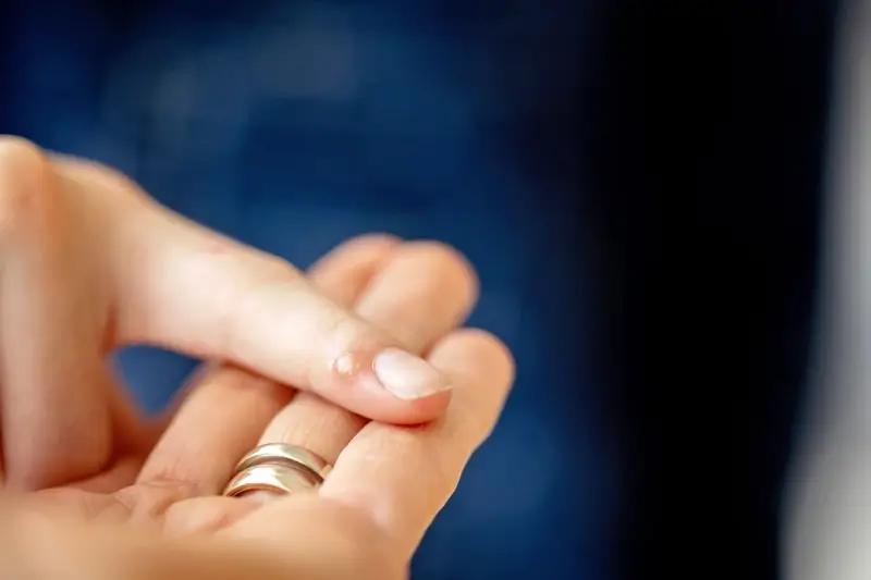 Jak wygląda korzeń kurzajki?