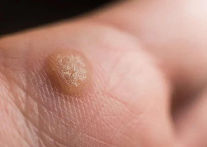 Jaskółcze ziele na kurzajki jak stosować?