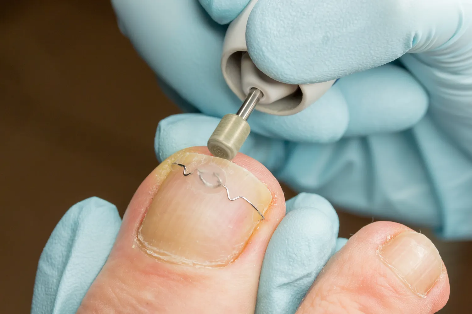 Podologia - pomoc dla stóp